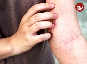 (تصاویر) با انواع بیماری های پوستی خارش دار آشنا شوید؛ از پسوریازیس تا اگزما