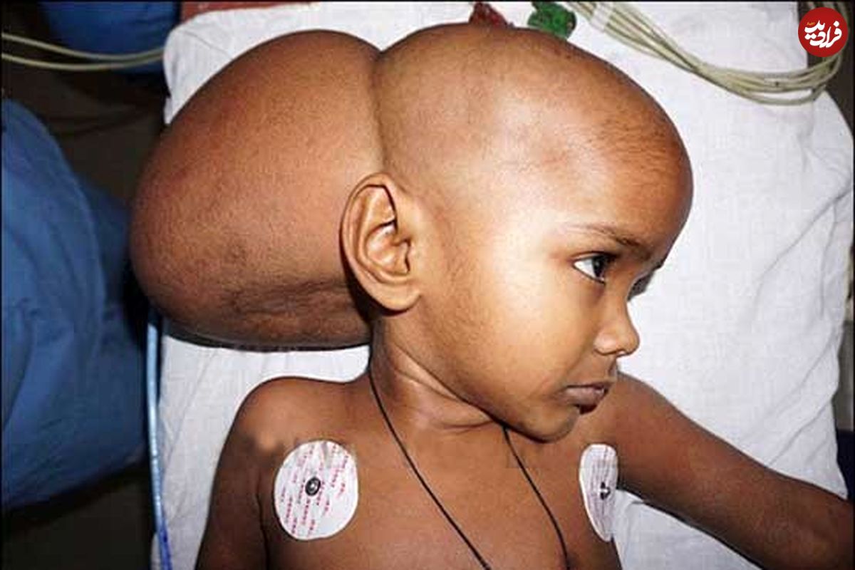 عکس/ تومور ۳ کیلویی در سر یک دختر!