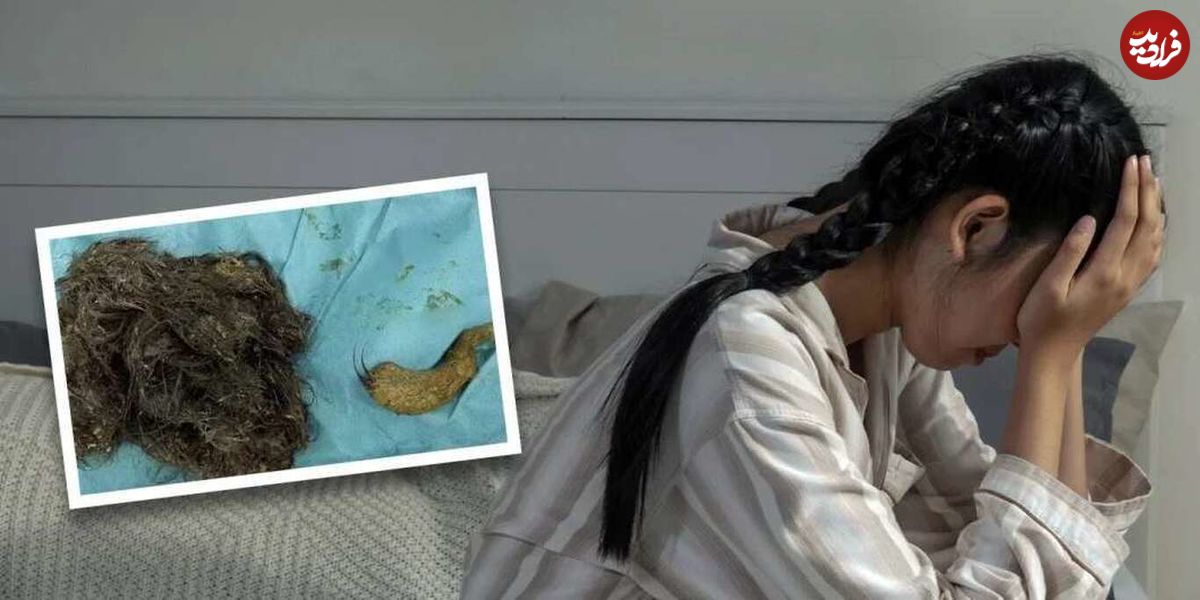 (عکس) ۳ کیلوگرم «مو» از شکم دختر چینی ۱۴ ساله خارج شد!