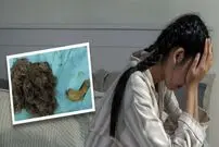(عکس) ۳ کیلوگرم «مو» از شکم دختر چینی ۱۴ ساله خارج شد!