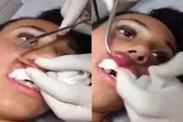 (تصاویر) خارج شدن کرم زنده از لب دختر جوان!