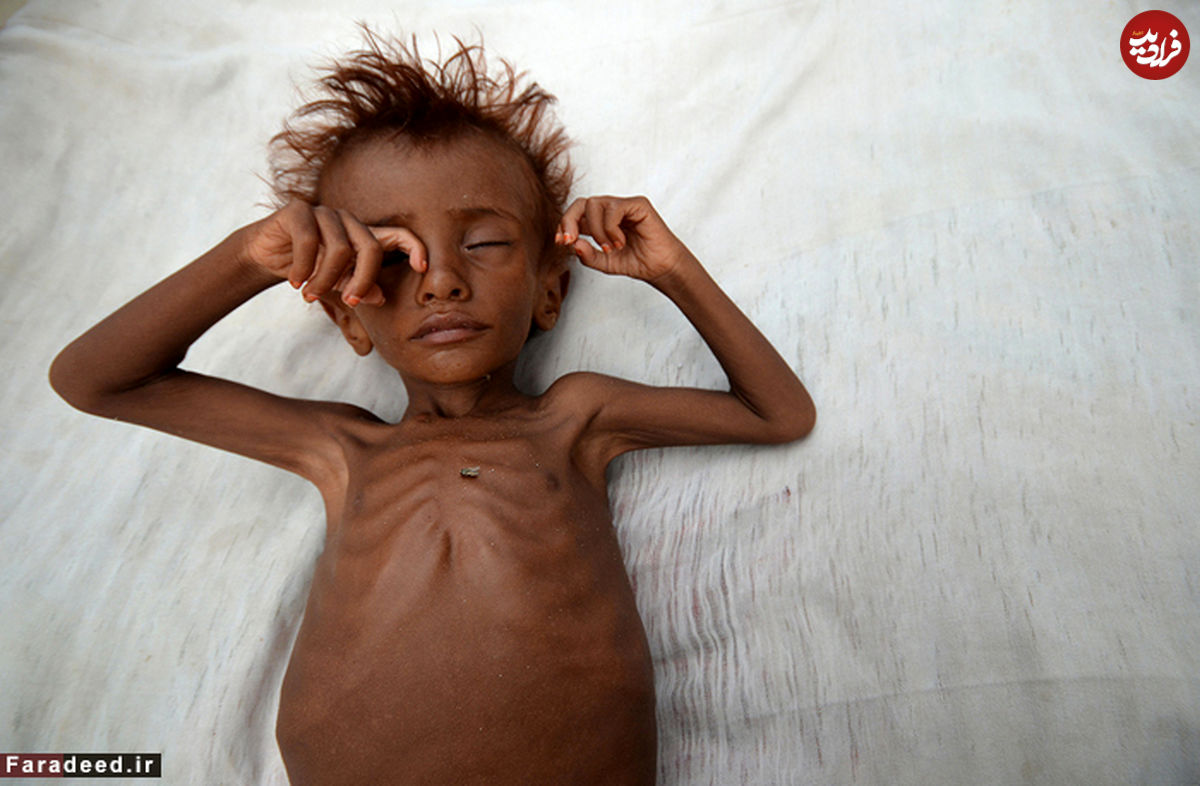 تصاویر/ کودکان قحطی‌زده یمن