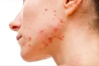(عکس) با «نقشه آکنه صورت» بیماری‌های پنهان خود را بشناسید!