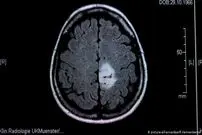 جلوگیری از سرطان با آب اکسیژنه