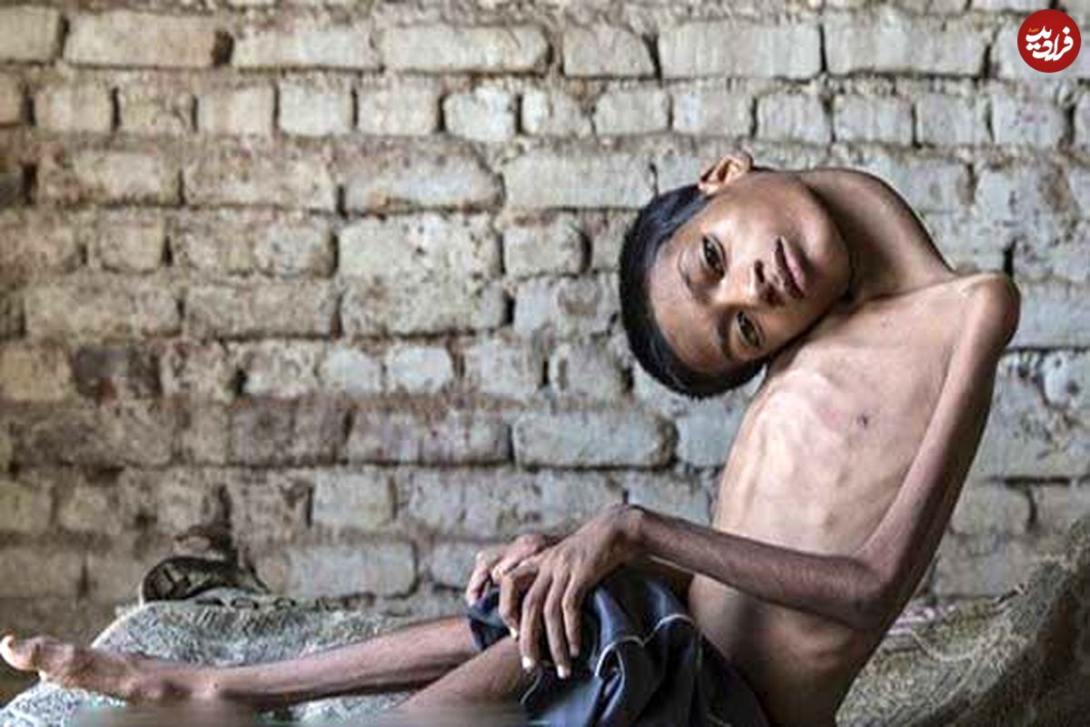 عکس/ جراحی گردن ۱۸۰ درجه‌ای یک پسر هندی