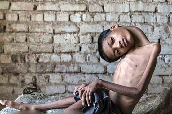 عکس/ جراحی گردن ۱۸۰ درجه‌ای یک پسر هندی