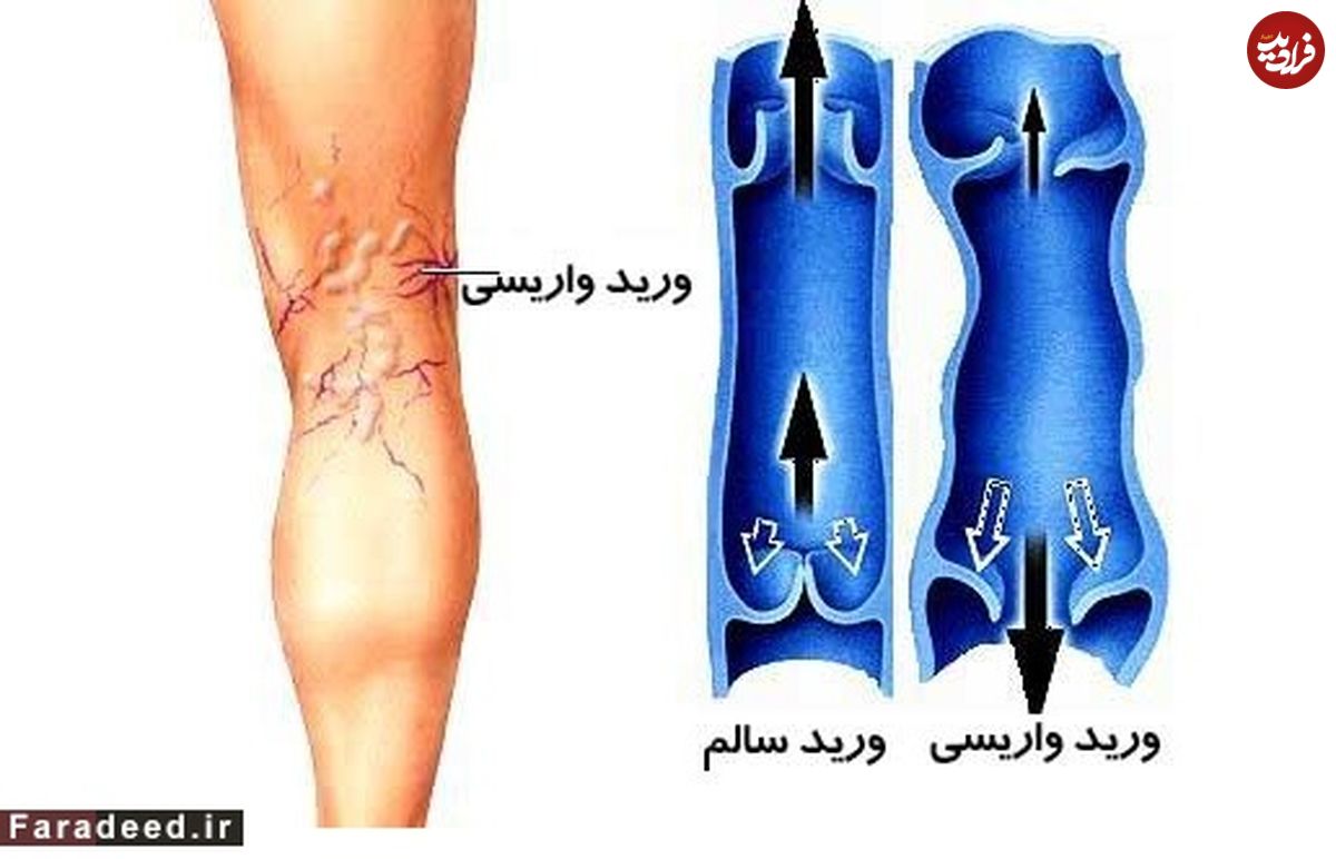 درمان طبیعی رگ‌های واریسی