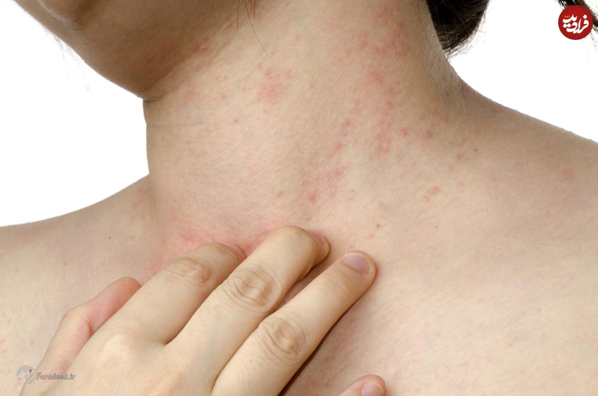 درمان و علت عفونت‌های پوستی چیست؟