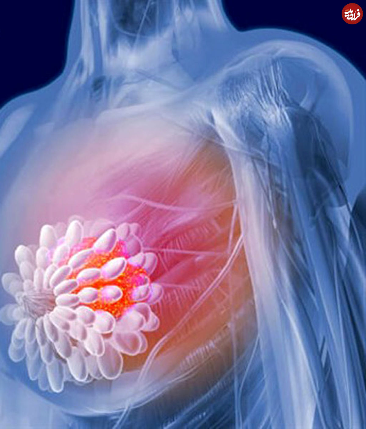 راهی برای پیش‌بینی ابتلای زنان به سرطان سینه