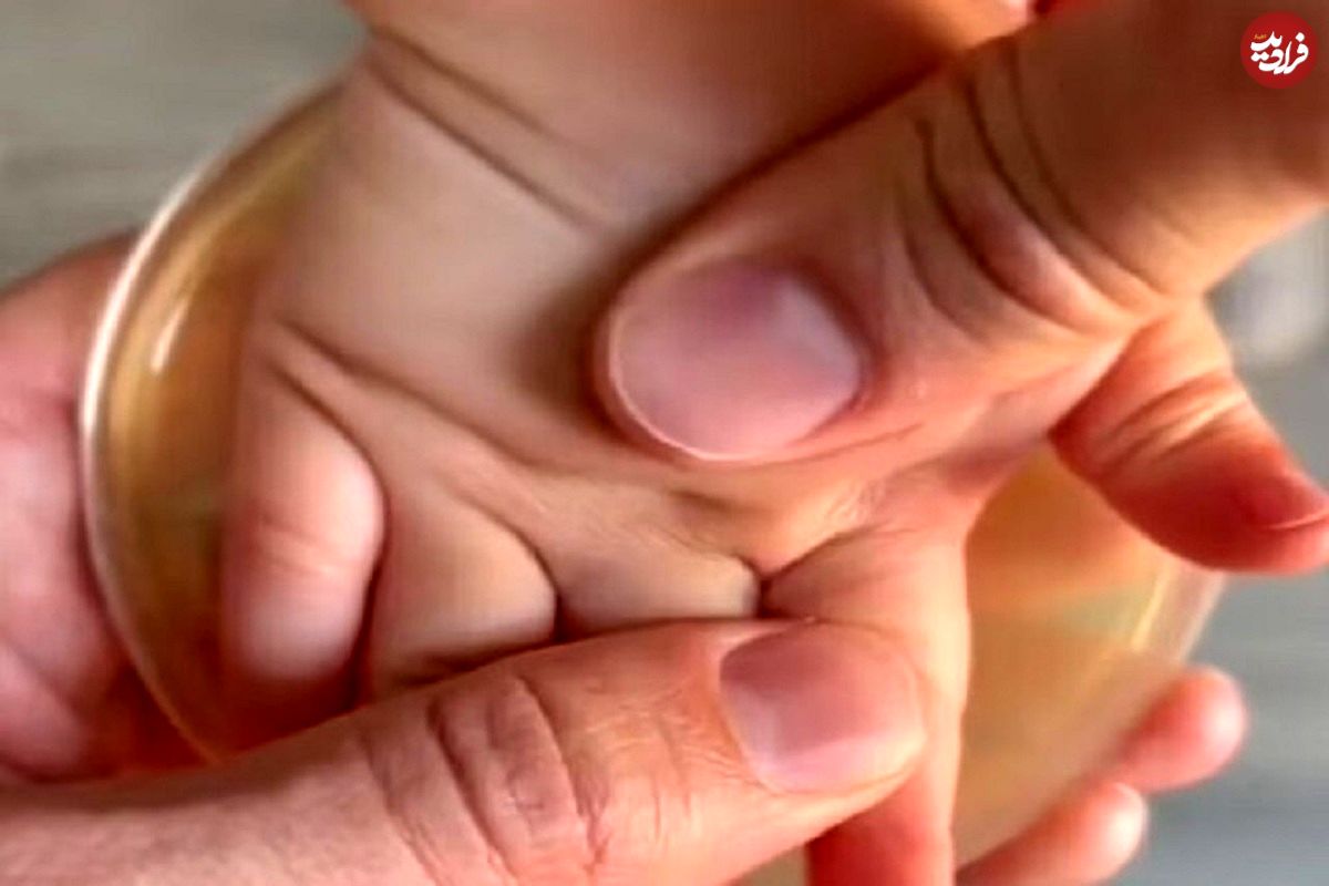 ویدئویی ترسناک از دورهمی باکتری‌ها در کف دست یک کودک