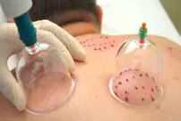 بهترین زمان برای حجامت چه وقتی است؟