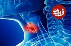 ببینید؛ علل شایع سرطان حنجره و راه‌های پیشگیری از آن