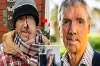 ببینید| بازسازی صورت مردی ۷۵ ساله با فناوری چاپ سه‌بعدی پس از سانحه تصادف 