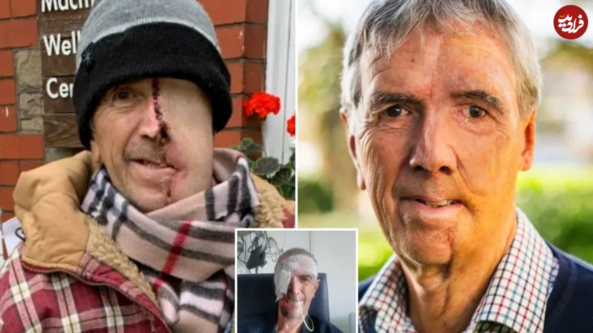 ببینید| بازسازی صورت مردی ۷۵ ساله با فناوری چاپ سهبعدی پس از سانحه تصادف