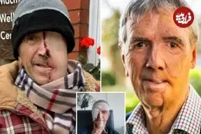 ببینید| بازسازی صورت مردی ۷۵ ساله با فناوری چاپ سه‌بعدی پس از سانحه تصادف 