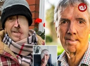 ببینید| بازسازی صورت مردی ۷۵ ساله با فناوری چاپ سهبعدی پس از سانحه تصادف