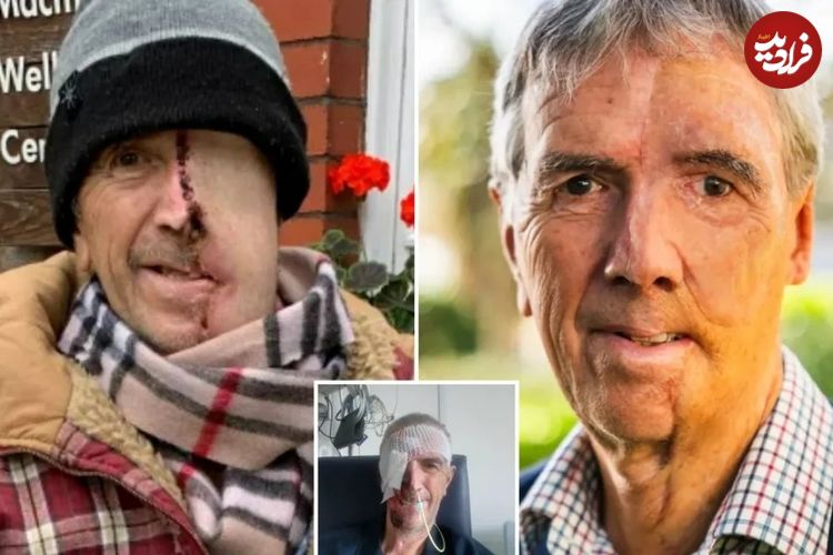 ببینید| بازسازی صورت مردی ۷۵ ساله با فناوری چاپ سهبعدی پس از سانحه تصادف