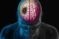 چگونه زمستان خطر سکته مغزی را افزایش می‌دهد؟