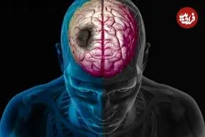 چگونه زمستان خطر سکته مغزی را افزایش می‌دهد؟