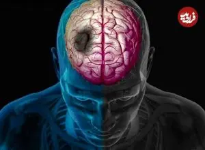 چگونه زمستان خطر سکته مغزی را افزایش می‌دهد؟