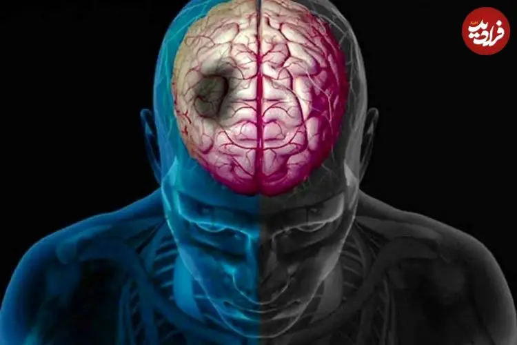 چگونه زمستان خطر سکته مغزی را افزایش می‌دهد؟