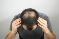 ( اینفوگرافیک) آمار کچلی مردان در کشورهای مختلف؛ ایران چندم است؟  