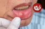 5 روش برای کاهش درد و کمک به بهبود آفت دهان