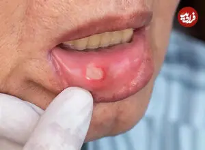 5 روش برای کاهش درد و کمک به بهبود آفت دهان