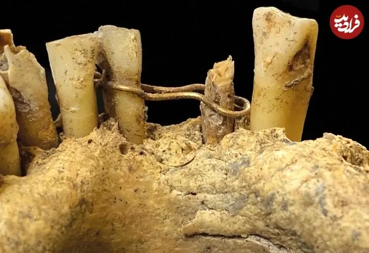 کشف «سیم‌کشی طلایی دندان» در گورستان 500 ساله