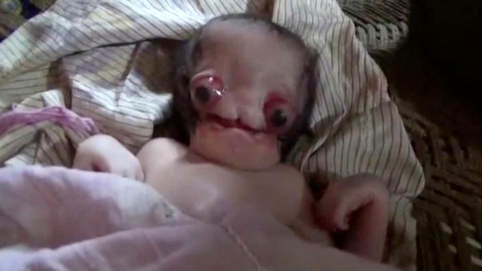 (تصاویر) تولد نوزاد عجیب‌الخلقه شبیه به موجودات فضایی در هند