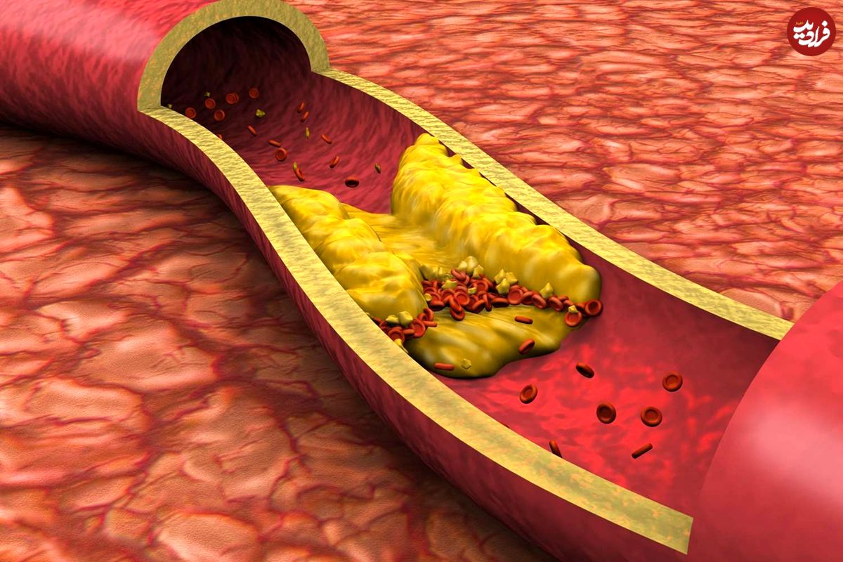 اگر این ۷ نشانه را دارید، ممکن است رگ‌های قلبتان مسدود شده باشند