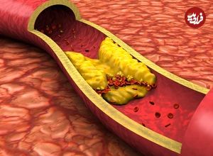 اگر این ۷ نشانه را دارید، ممکن است رگ‌های قلبتان مسدود شده باشند