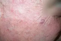 گره گوشی قرمز، یعنی ابتلا به نوعی سرطان؛ احتمال درگیری غدد لفناوی در این سرطان