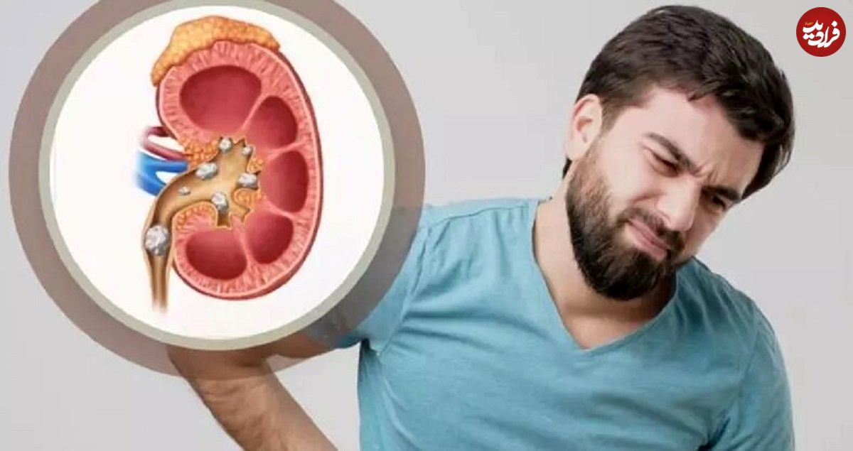 ببینید؛ آیا آب مصرفی در کشور باعث سنگ کلیه می‌شود؟ 