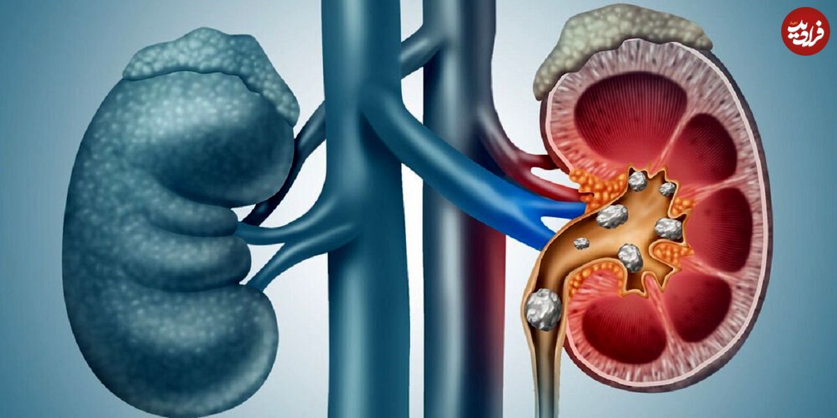 ببینید؛ جراحی برای سنگ‌کلیه؛ آری یا خیر؟