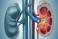 ببینید؛ جراحی برای سنگ‌کلیه؛ آری یا خیر؟