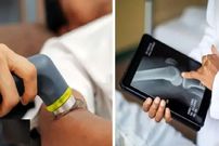 عکس؛ ترمیم شکستگی استخوان با تفنگ!