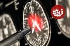 چرا زنان بیشتر به «ام‌اس» مبتلا می‌شوند؟