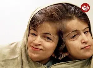 عکس| سفر زمان؛ «لاله و لادن» در 29 سالگی و پیش از جراحی در سنگاپور؛ سال 82
