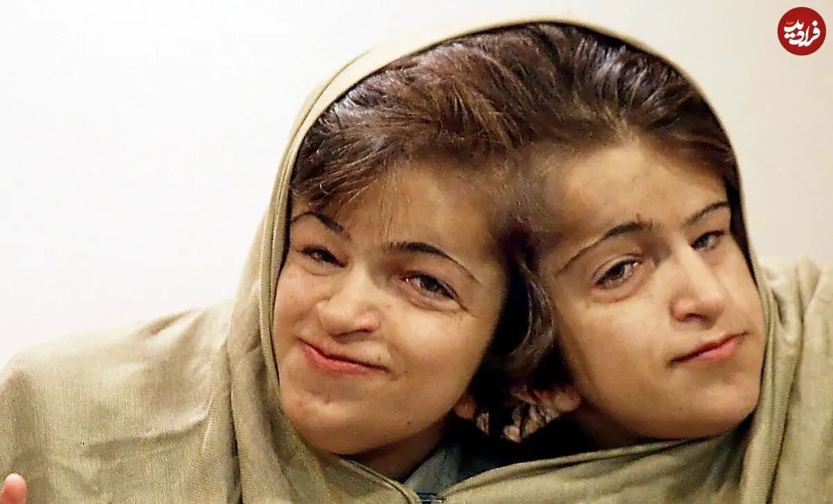 عکس| سفر زمان؛ «لاله و لادن» در 29 سالگی و پیش از جراحی در سنگاپور؛ سال 82