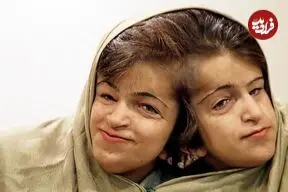 عکس| سفر زمان؛ «لاله و لادن» در 29 سالگی و پیش از جراحی در سنگاپور؛ سال 82