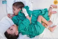 (ویدئو) جداسازی دوقلو‌های به‌هم چسبیده؛ احسان شانس زنده ماندن ندارد