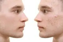 نکاتی که باید درباره جوش‌های صورت بدانید؛ این جوش ها را فشار ندهید