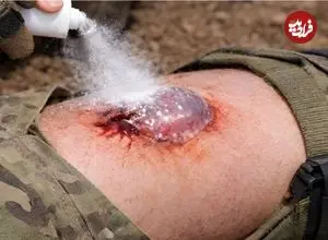 توقف یک ثانیه‌ای خونریزی ممکن شد