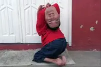 داستان الهام بخش زندگی مردی که با سری وارونه به دنیا آمده و نمی خواهد جراحی کند
