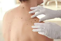 چگونه تشخیص دهیم که یک خال سرطانی است یا نه؟