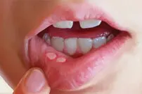 زخم‌های دردناک دهان از کجا می‌آیند؟؛ دلایل شایع و راه‌های کاهش درد و پیشگیری