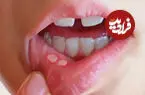زخم‌های دردناک دهان از کجا می‌آیند؟؛ دلایل شایع و راه‌های کاهش درد و پیشگیری