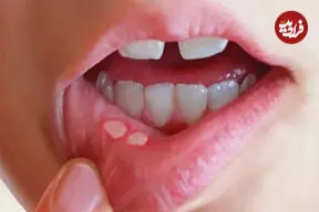 زخم‌های دردناک دهان از کجا می‌آیند؟؛ دلایل شایع و راه‌های کاهش درد و پیشگیری