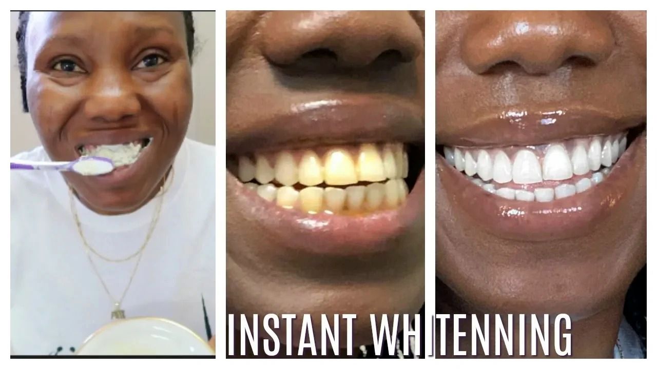 (ویدئو) یک روش ساده برای سفید کردن دندان با زنجبیل، جوش شیرین و لیموترش